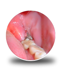 how-wisdom-teeth-infection-removal-helps-pain-fast-big-0