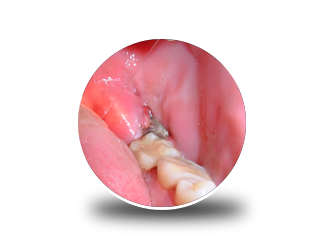 how-wisdom-teeth-infection-removal-helps-pain-fast-small-0