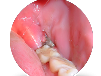 how-wisdom-teeth-infection-removal-helps-pain-fast