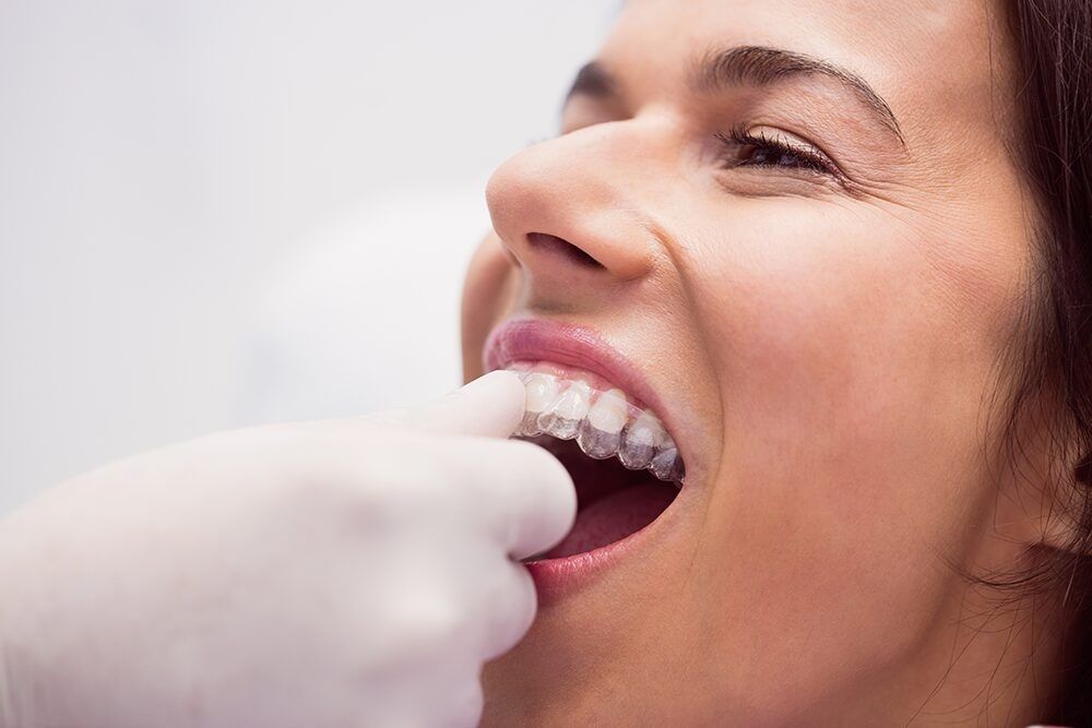 how-long-do-snap-on-teeth-last-for-houston-patients-big-0
