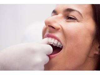 how-long-do-snap-on-teeth-last-for-houston-patients-small-0