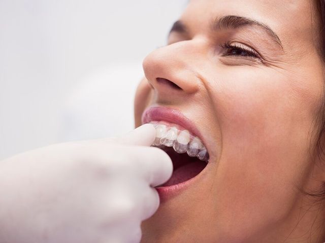 how-long-do-snap-on-teeth-last-for-houston-patients