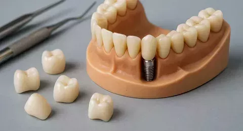 wilmington-dental-implants-specialist-expert-smile-care-big-0