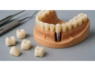 wilmington-dental-implants-specialist-expert-smile-care-small-0