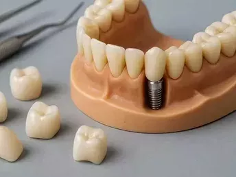 wilmington-dental-implants-specialist-expert-smile-care