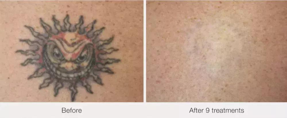best-options-for-tattoo-removal-nj-services-near-you-big-0