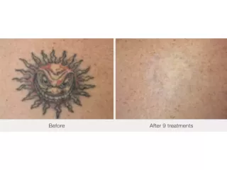 best-options-for-tattoo-removal-nj-services-near-you-small-0