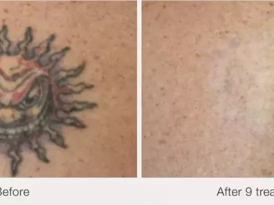 best-options-for-tattoo-removal-nj-services-near-you