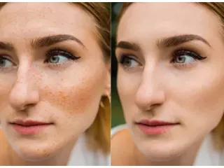 effective-solutions-for-age-spots-removal-treatment-small-0