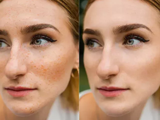 effective-solutions-for-age-spots-removal-treatment