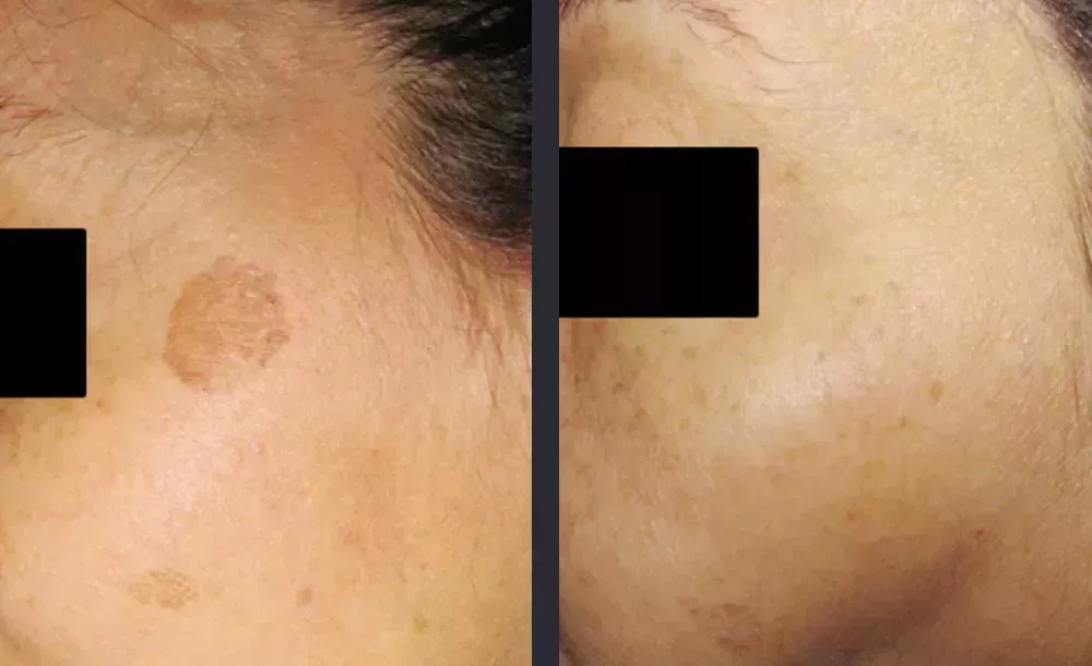 best-treatment-for-melasma-for-clear-even-skin-big-0