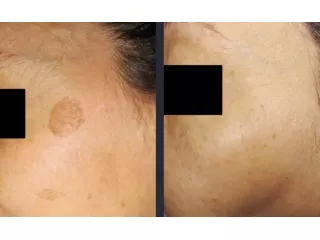 best-treatment-for-melasma-for-clear-even-skin-small-0