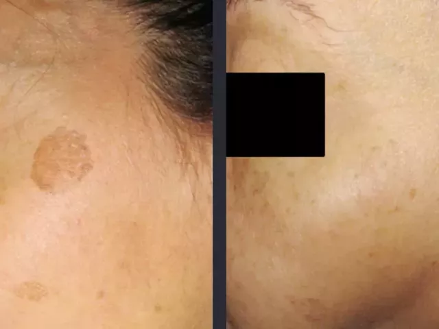 best-treatment-for-melasma-for-clear-even-skin