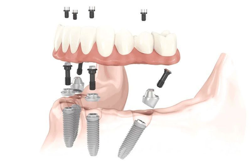 affordable-dentures-big-0