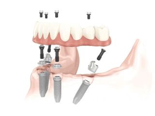 affordable-dentures-small-0