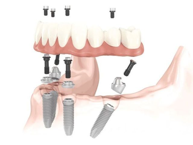 affordable-dentures
