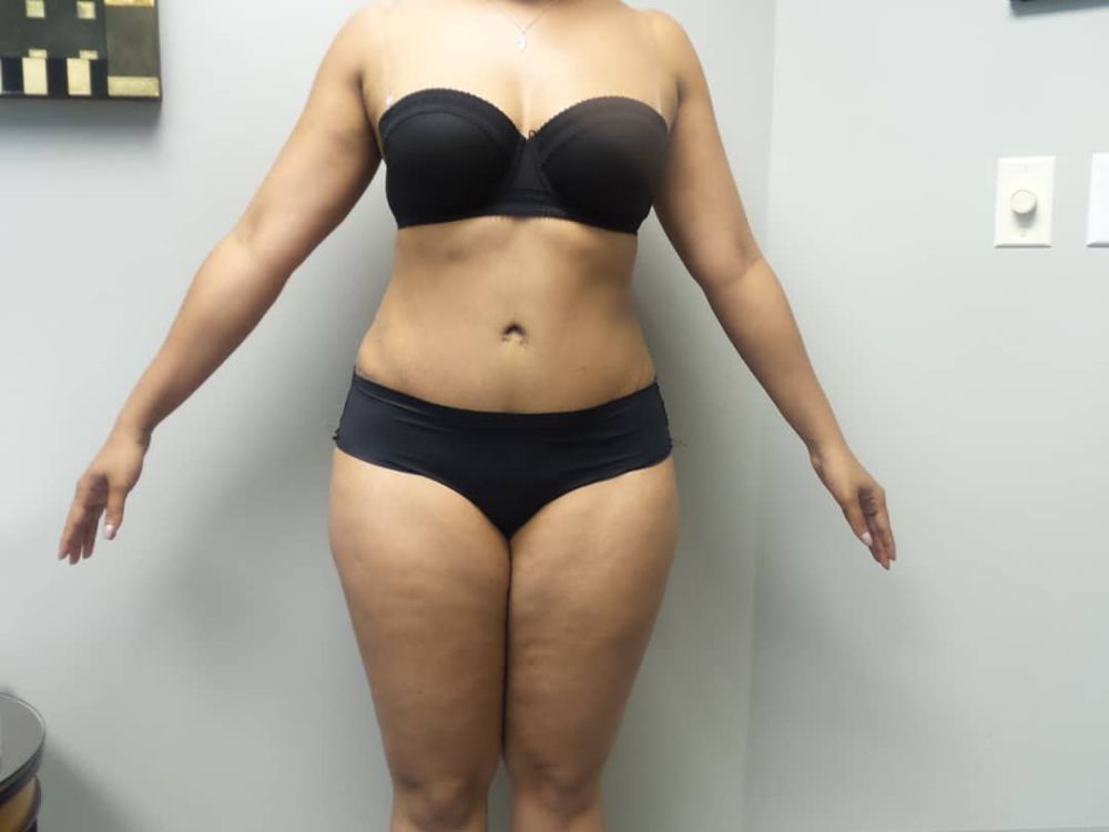 regain-your-pre-baby-body-with-mommy-makeover-seattle-big-1