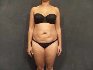 regain-your-pre-baby-body-with-mommy-makeover-seattle-small-0