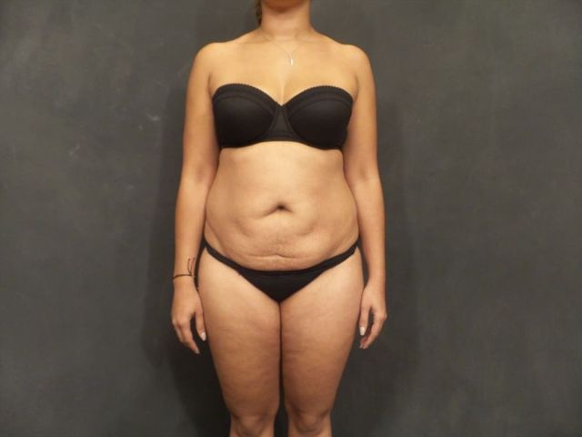 regain-your-pre-baby-body-with-mommy-makeover-seattle
