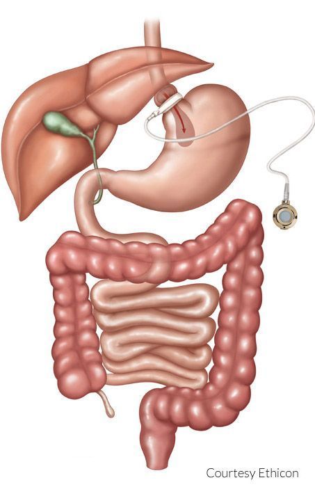 lap-band-surgery-service-in-tuscaloosa-alabama-big-0