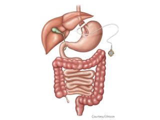 lap-band-surgery-service-in-tuscaloosa-alabama-small-0