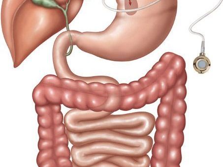 lap-band-surgery-service-in-tuscaloosa-alabama