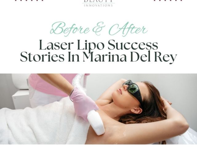 before-after-laser-lipo-success-stories-in-marina-del-rey