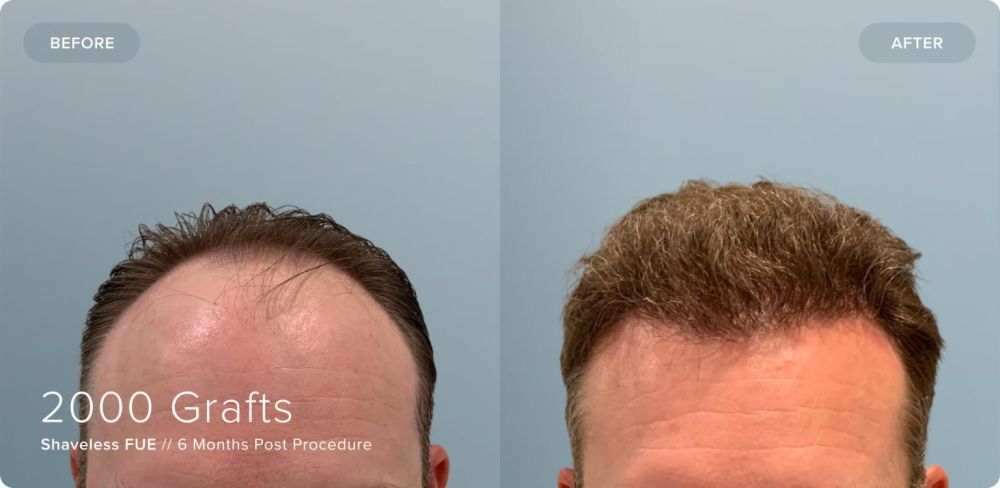 what-to-expect-from-hair-transplant-before-and-after-photos-big-0
