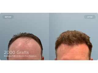 what-to-expect-from-hair-transplant-before-and-after-photos-small-0