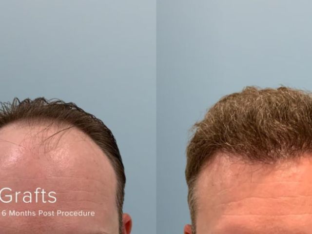 what-to-expect-from-hair-transplant-before-and-after-photos