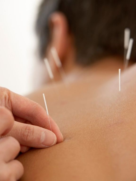 acupuncture-for-back-pain-upper-west-side-big-0