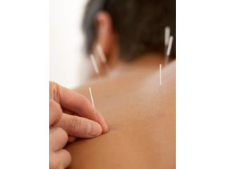 acupuncture-for-back-pain-upper-west-side-small-0