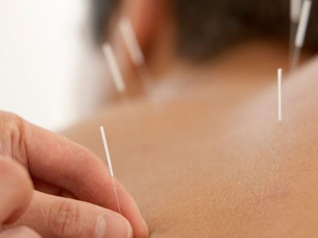 acupuncture-for-back-pain-upper-west-side