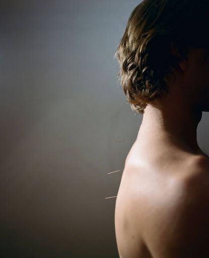 acupuncture-upper-east-side-treatments-big-0