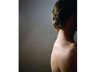 acupuncture-upper-east-side-treatments-small-0