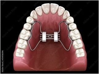 how-long-does-invisalign-treatment-take-in-north-miami-beach-small-0