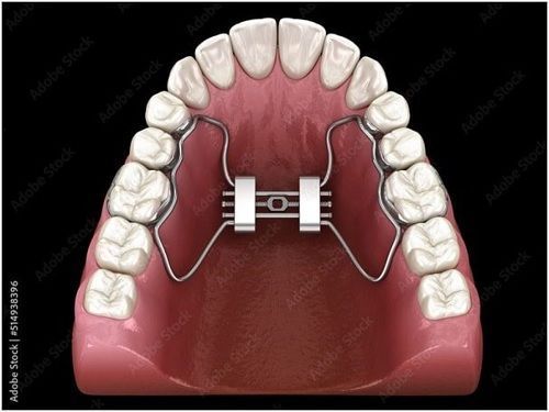 how-long-does-invisalign-treatment-take-in-north-miami-beach