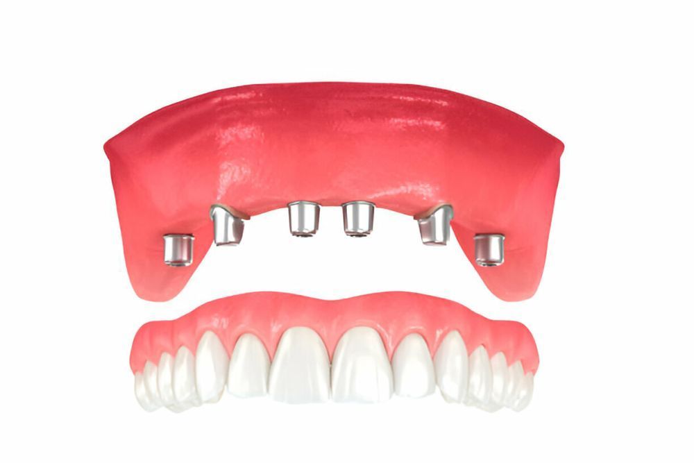 permanent-teeth-restoration-dental-implants-in-bromley-big-0