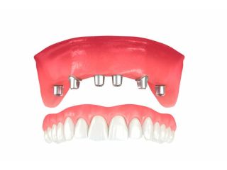 permanent-teeth-restoration-dental-implants-in-bromley-small-0
