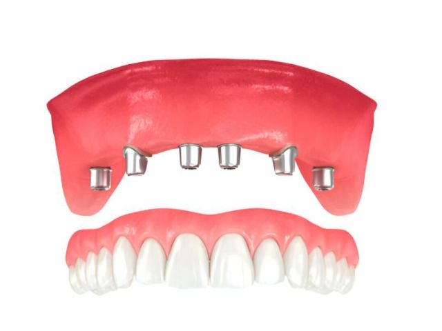 permanent-teeth-restoration-dental-implants-in-bromley