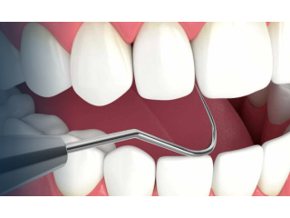 full-mouth-reconstruction-advanced-smile-restoration-small-0