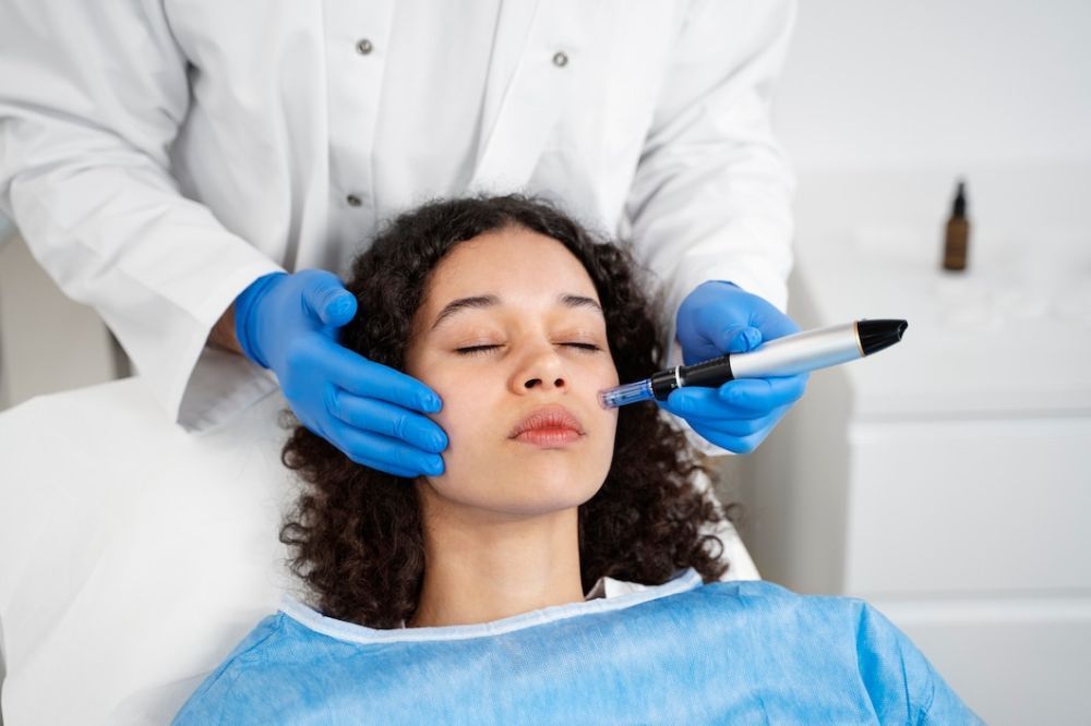 best-microneedling-for-acne-scars-morgan-hill-big-0