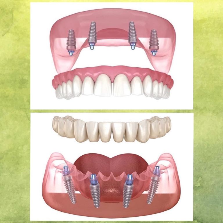 implant-dentist-in-simi-valley-for-strong-natural-smiles-big-0