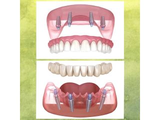 implant-dentist-in-simi-valley-for-strong-natural-smiles-small-0