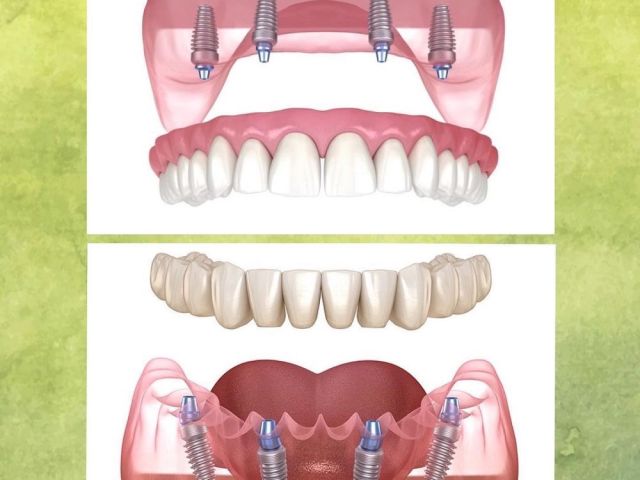 implant-dentist-in-simi-valley-for-strong-natural-smiles