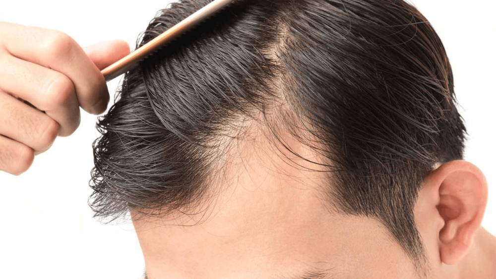 best-hair-fall-solution-in-edinburgh-big-0