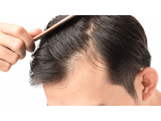 best-hair-fall-solution-in-edinburgh-small-0