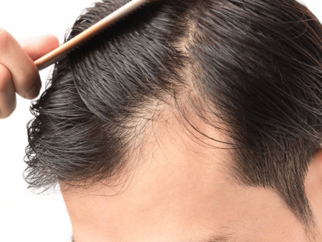 best-hair-fall-solution-in-edinburgh