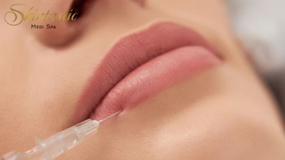 lip-fillers-riverside-for-natural-and-fuller-lips-big-0
