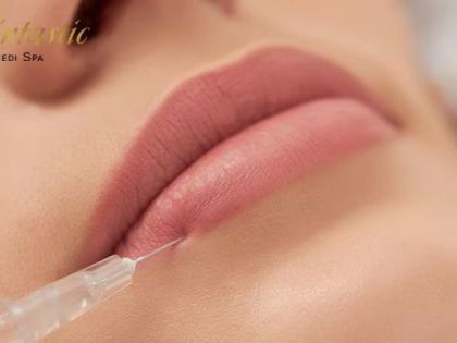 lip-fillers-riverside-for-natural-and-fuller-lips